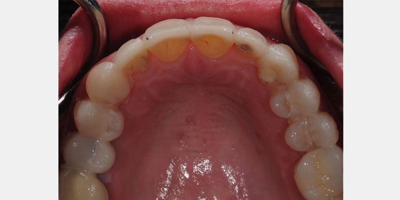 Filtraciones en carillas dentales: por qué el sellado marginal se deteriora y qué alternativas existen cuando aparece el problema